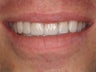 10 Porcelain Veneers