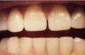 Porcelain Veneers