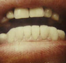 Porcelain Veneers