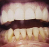 Porcelain Veneers