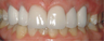 Old crowns treated with new whitest porcelain crowns and veneers