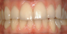 Natural shade veneers