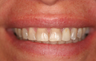  Porcelain Veneers Smile Makeover