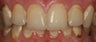 Porcelain Veneers