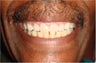 Veneers