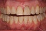Veneers