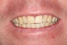 Porcelain Veneers/ Smile Makeover