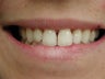 Porcelain Veneers