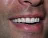 Veneers
