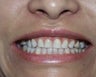 Porcelain Veneers