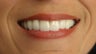 porcelain veneers