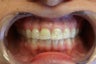 6 veneer