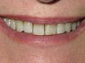 Veneers