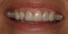 Porcelain Veneers