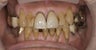 Porcelain Veneers