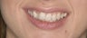 porcelain veneers