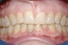 Porcelain Veneers four front teeth