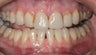 Replacement Porcelain Veneers
