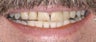 Porcelain veneers