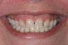 Empress Porcelain Teeth Veneers