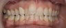 Porcelain Veneers