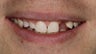 Porcelain Bridge and Veneer