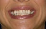 Veneers