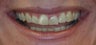 Porcelain Veneers