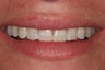 Porcelain Veneers