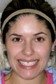 Eight porcelain veneers on upper teeth closing midline space.