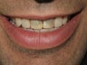 Teeth whitening and veneers