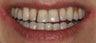 Porcelain veneers and whitening