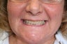 Porcelain Veneers