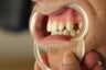 porcelain bridge with veneers replacing teeth