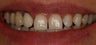Porcelain Veneers and Crowns