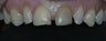Porcelain Veneers