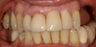 Porcelain crowns and porcelain veneers