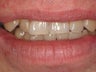 10 Porcelain Veneers