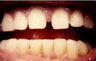 Porcelain Veneers