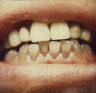 Porcelain Veneers