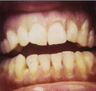 Porcelain Veneers