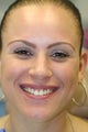 Porcelain Veneers