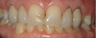 Old crowns treated with new whitest porcelain crowns and veneers
