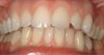 Natural shade veneers