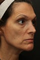 Portrat PSR3 Plasma Skin Resurfacing