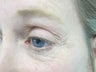 Portrait Plasma Resurfacing
