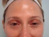 "No-Lift" Eye Lift with Portrait PSR and Filler Injection