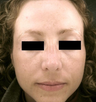Pro-Fractional plus Chemical Peel