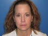 Microlaser Peel, Profractional Laser, and Broad Band Light treament
