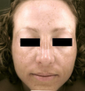Pro-Fractional plus Chemical Peel